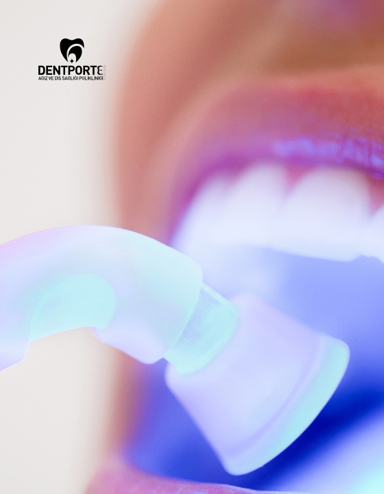 Dentporte | Tedavilerimiz | Estetik Dolgu