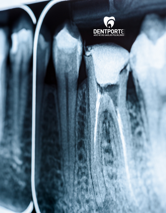 Dentporte | Tedavilerimiz | Kanal Tedavisi