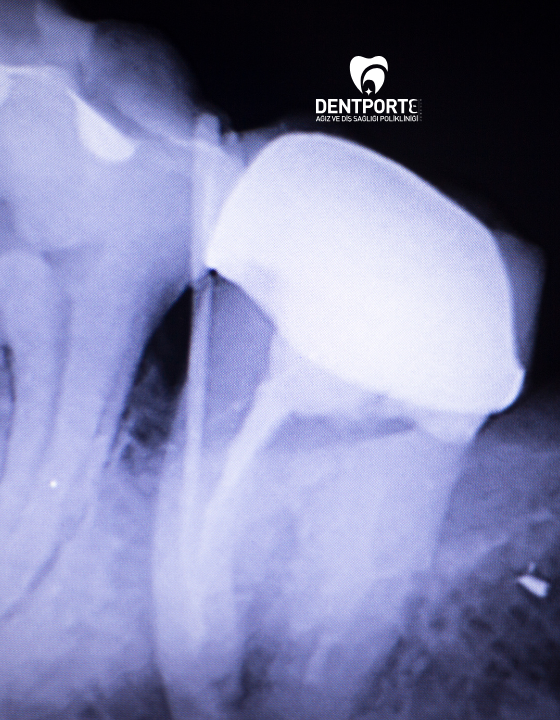 Dentporte | Tedavilerimiz | Apikal Rezeksiyon