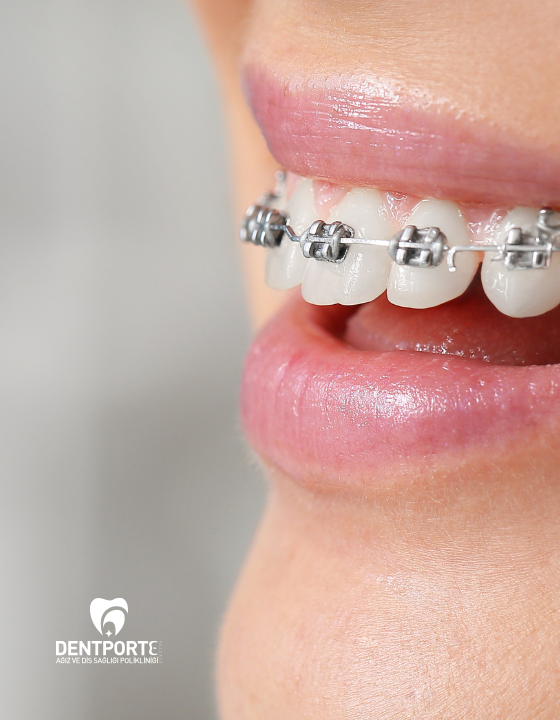 Dentporte | Tedavilerimiz | Ortodontik Tedavi