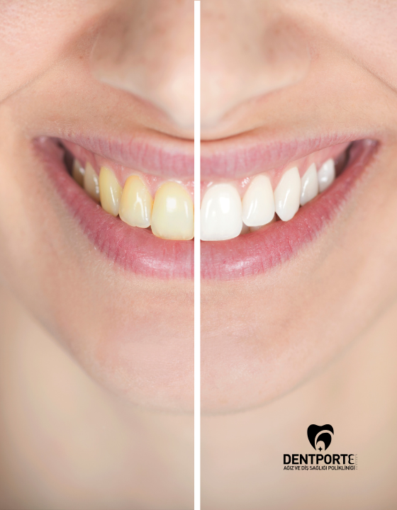 Dentporte | Tedavilerimiz | Bleaching