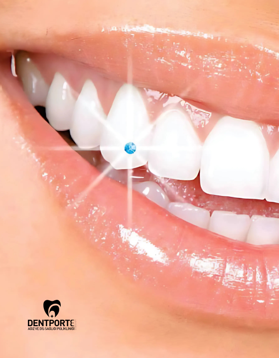 Dentporte | Tedavilerimiz | Estetik Diş Süsleri